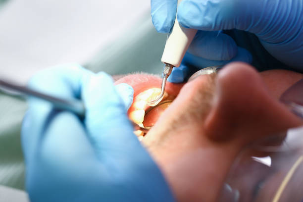 Best Emergency Dental Care for Abscessed Tooth in Moraga, CA
